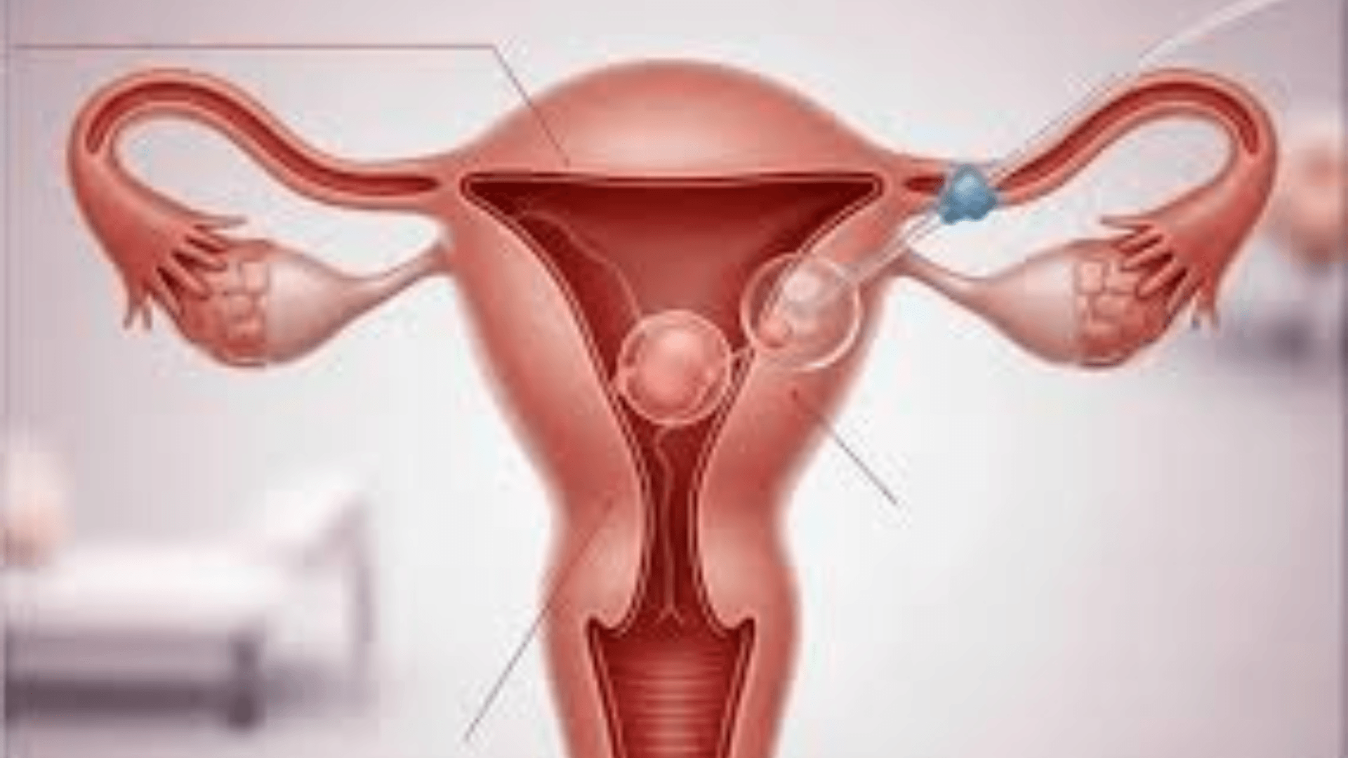 Pregnancy After Fallopian Tube Removal:Complete Guide to Success & IVF